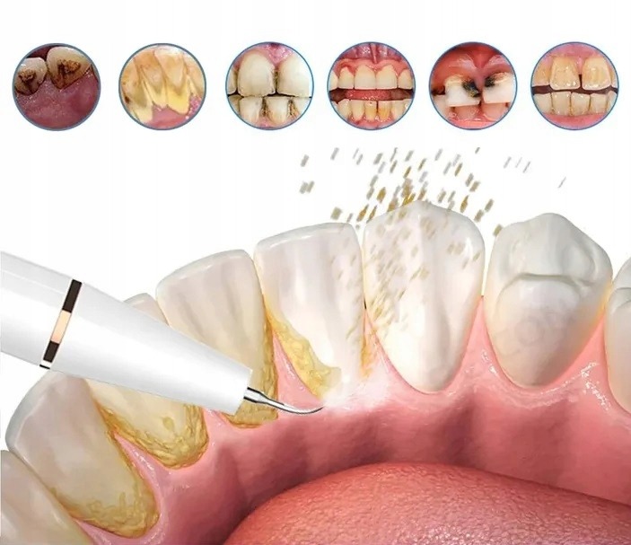  odstraňovač zubného kameňa